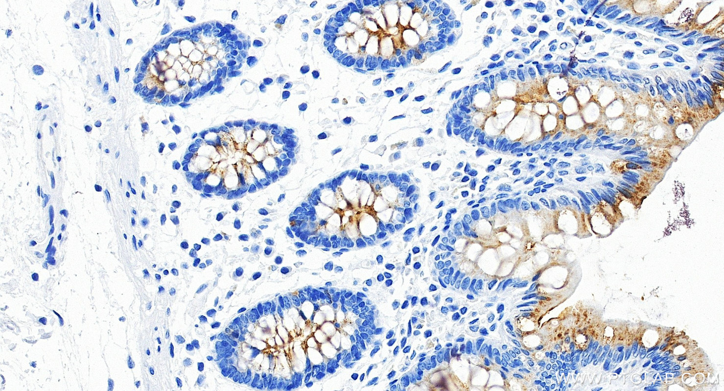 Immunohistochemical analysis of paraffin-embedded human colon tissue slide using <a class='green' href='/productredirect?CatalogNo=87107-2-RR' target='_blank'>87107-2-RR</a> (MUC13 antibody) at dilution of 1:1000 (under 20x lens). Heat mediated antigen retrieval with Tris-EDTA buffer (pH 9.0). This data was developed using the same antibody clone with 87107-2-PBS in a different storage buffer formulation. IHC staining of human colon using 87107-2-RR (same clone as 87107-2-PBS)