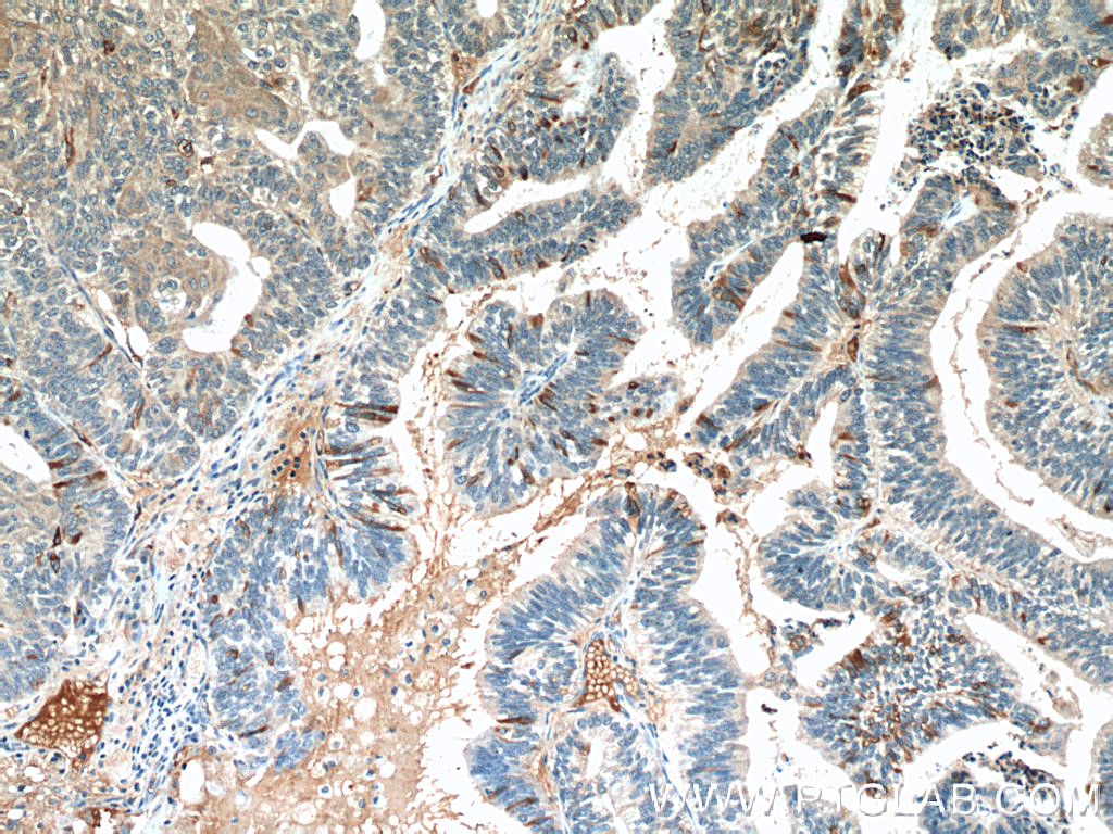 IHC staining of human ovary tumor using 60261-1-Ig