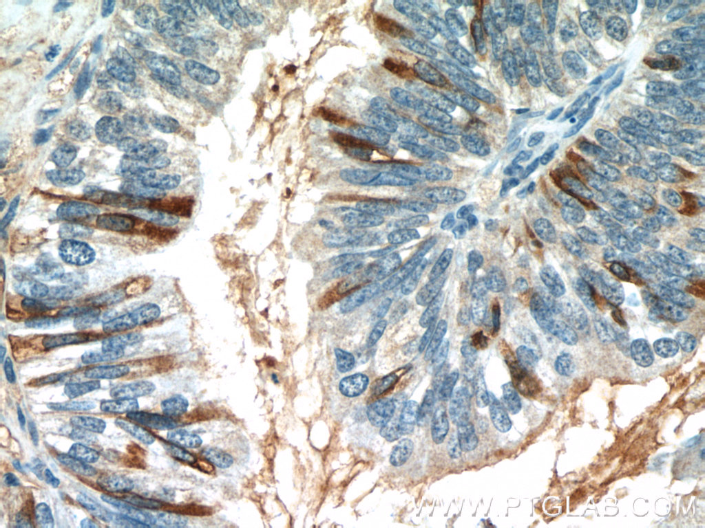 IHC staining of human ovary tumor using 60261-1-Ig (same clone as 60261-1-PBS)