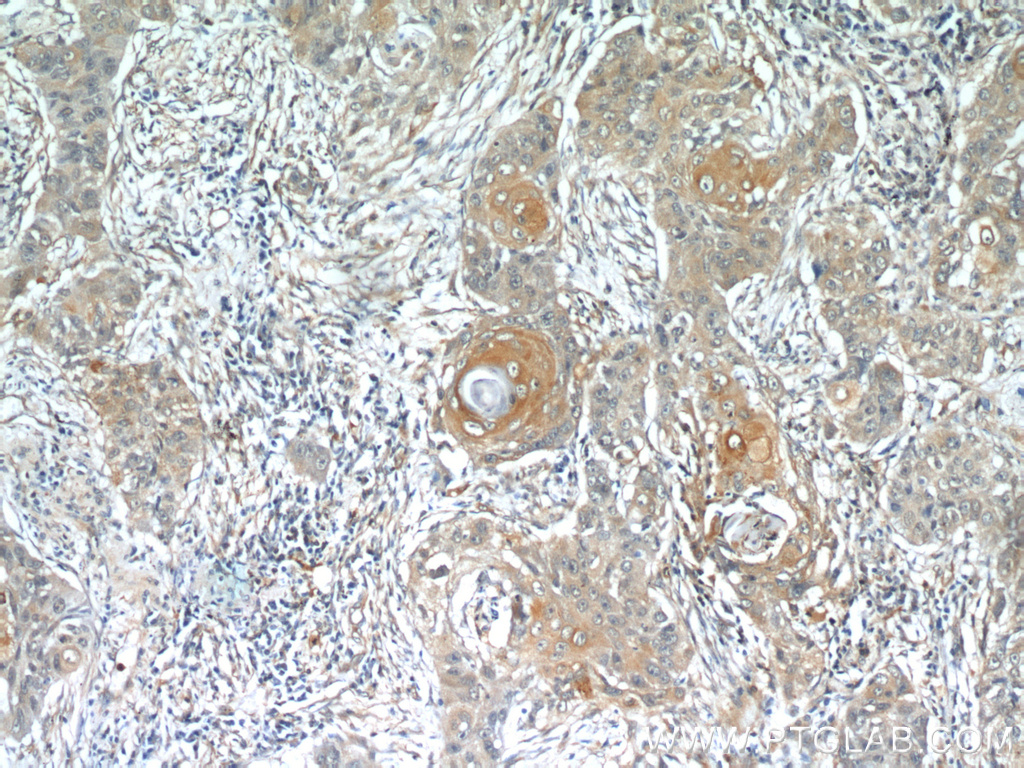 IHC staining of human lung cancer using 55489-1-AP