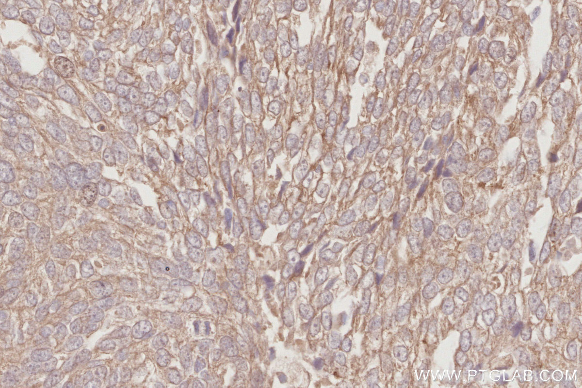 IHC staining of human ovary cancer using 26567-1-AP IHC staining of human ovary cancer using 26567-1-AP