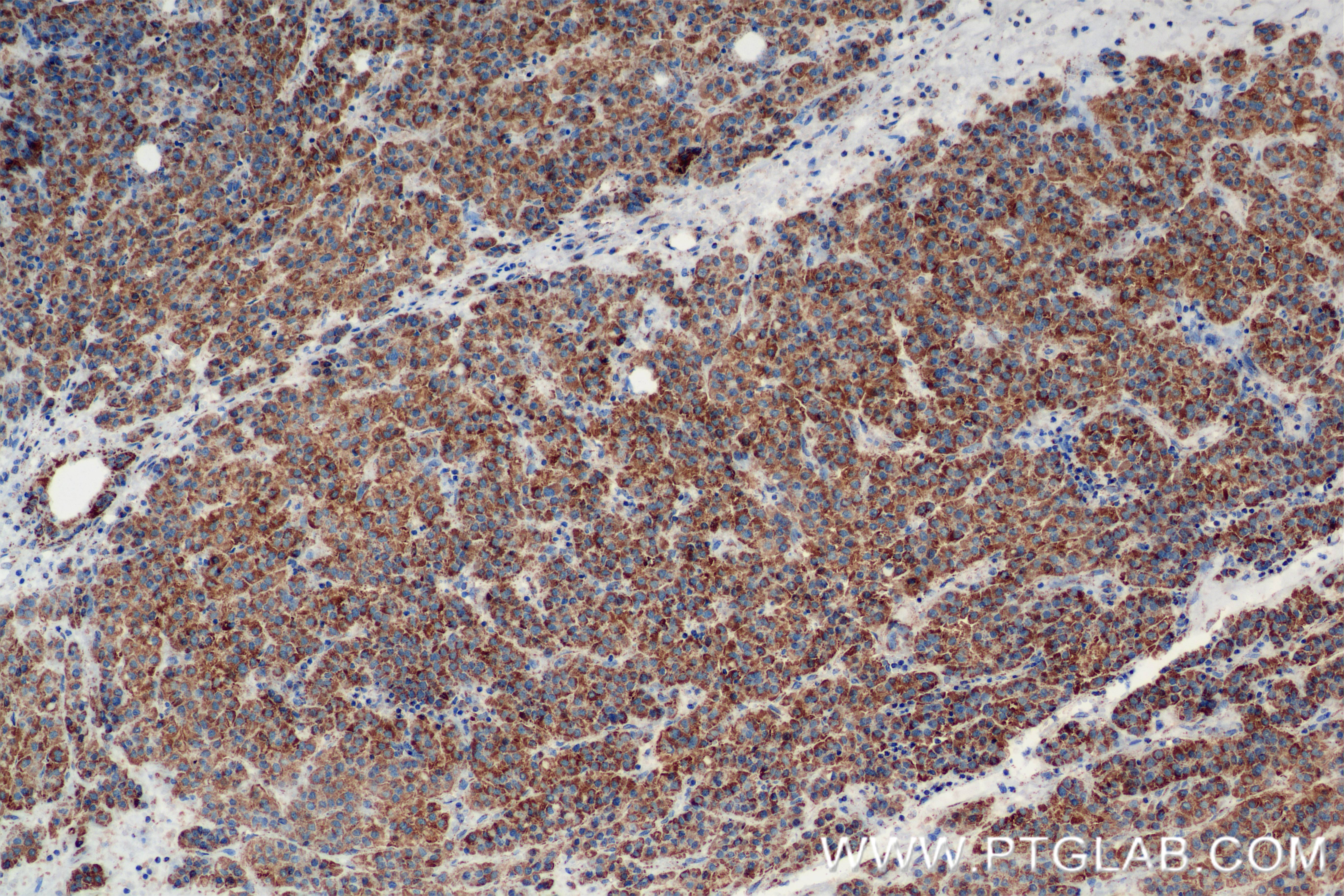 IHC staining of Human Hepatocellular cancer using 84879-6-RR