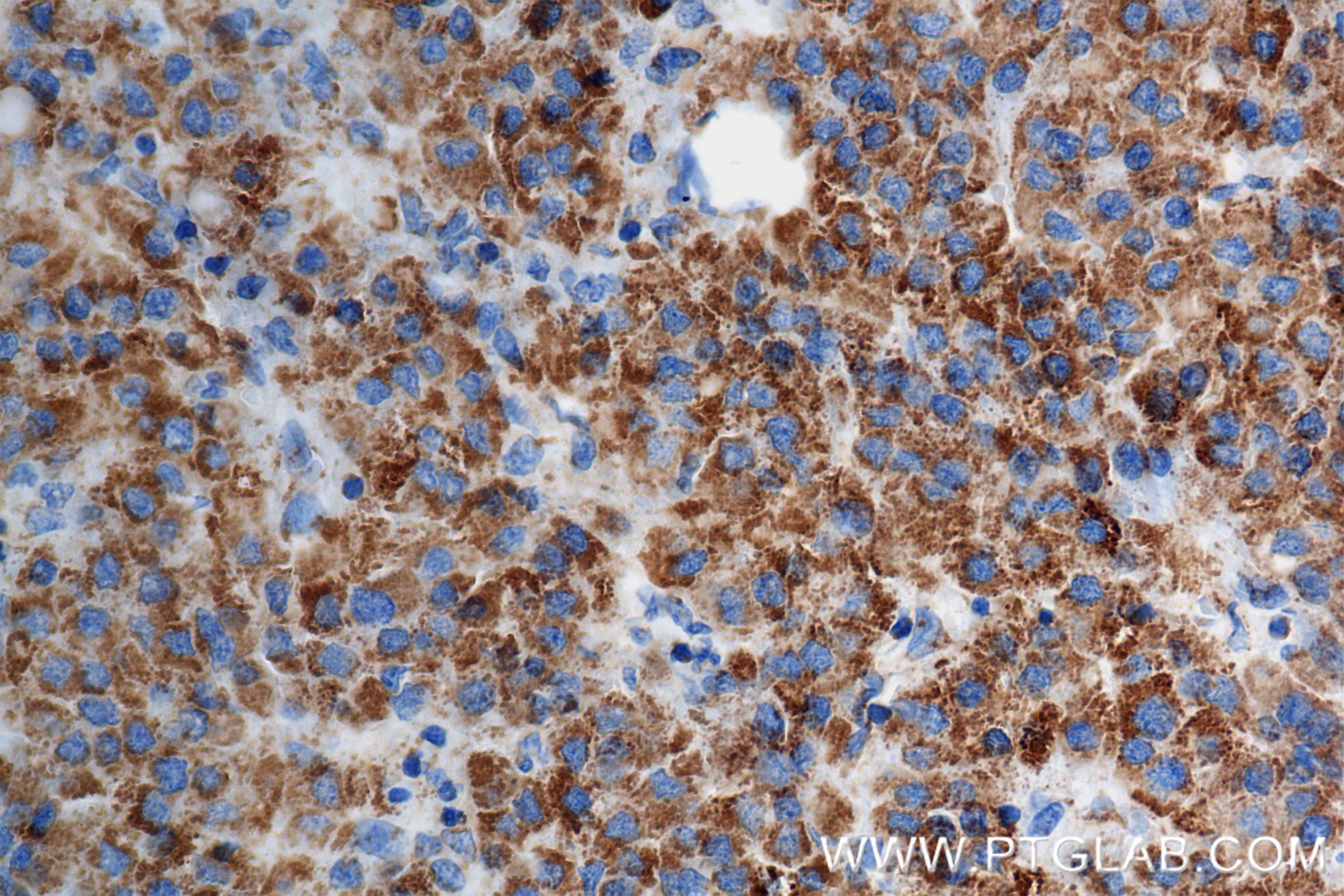 IHC staining of Human Hepatocellular cancer using 84879-6-RR