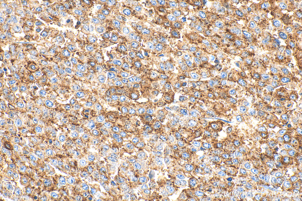 IHC staining of human colon cancer using 13750-1-AP