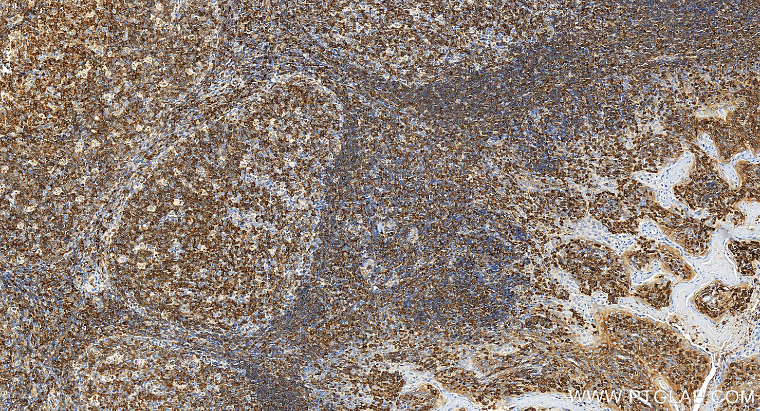 IHC staining of human tonsillitis using 13750-1-AP