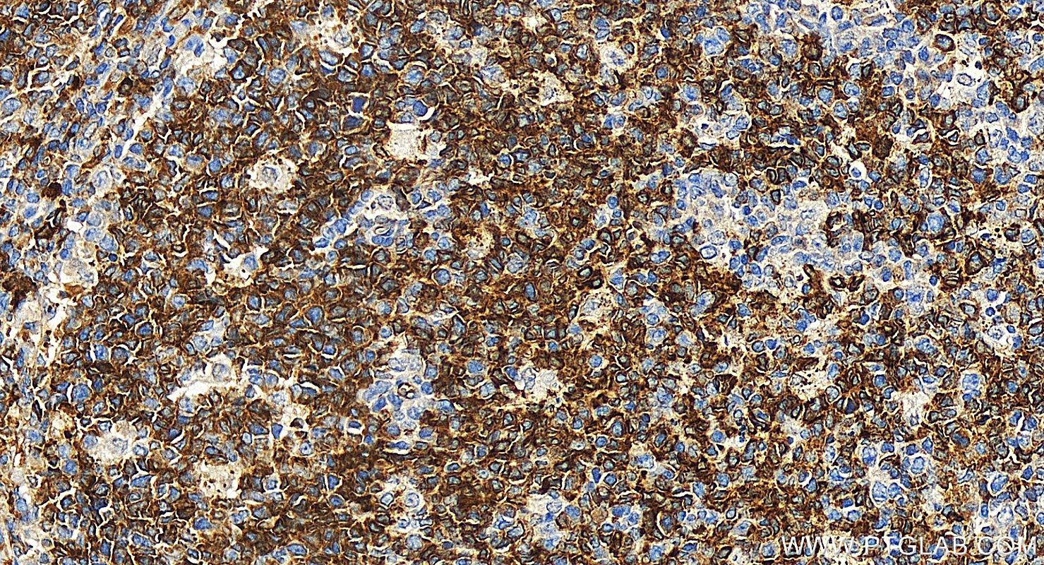 IHC staining of human tonsillitis using 13750-1-AP