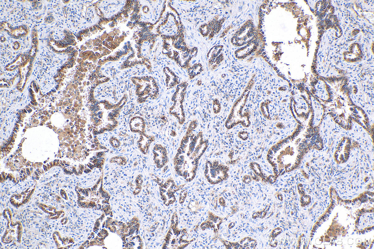 IHC staining of human lung cancer using 82677-1-RR