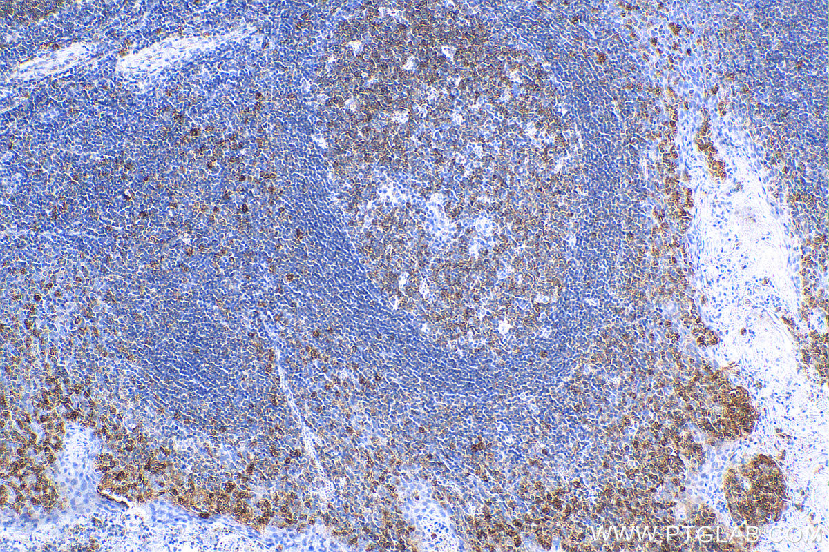 IHC staining of human tonsillitis using 82677-1-RR