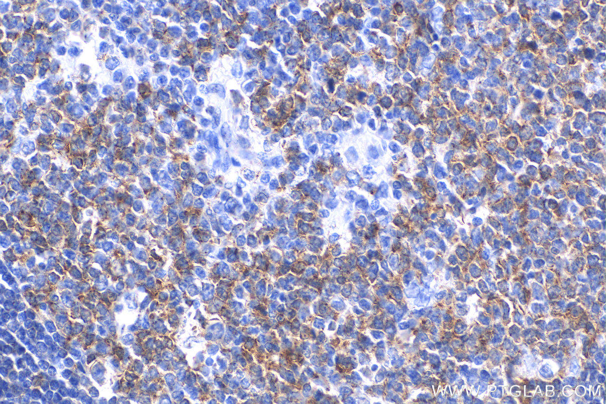 IHC staining of human tonsillitis using 82677-1-RR