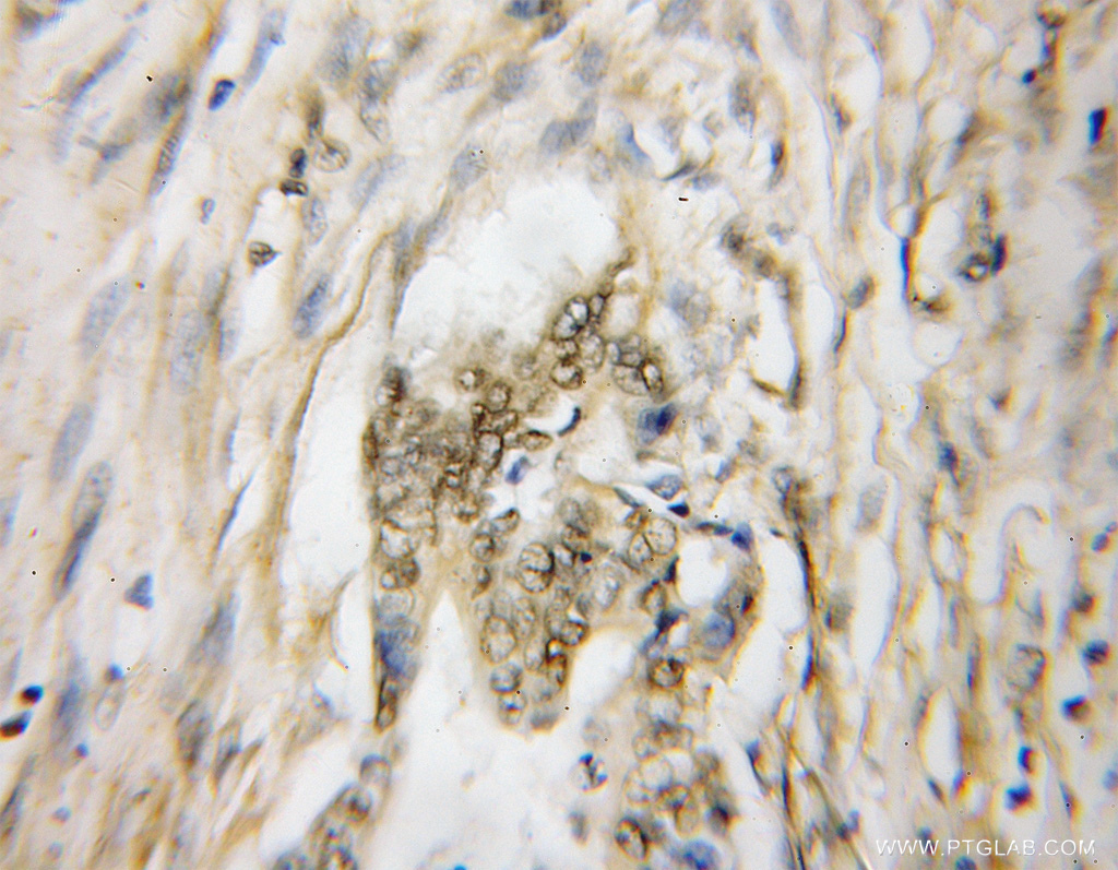 IHC staining of human pancreas cancer using 12022-1-AP