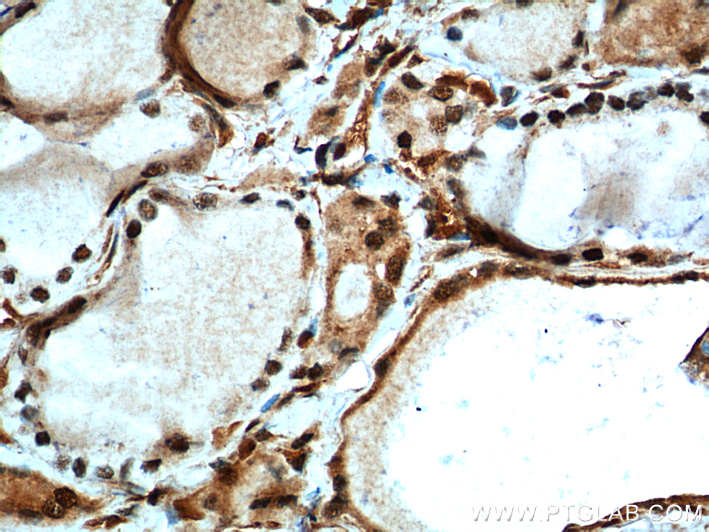 IHC staining of human thyroid cancer using 10159-2-AP
