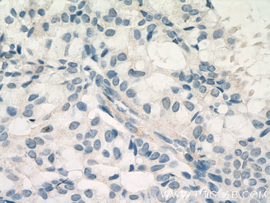 IHC staining of human breast hyperplasia using 60222-1-Ig (same clone as 60222-1-PBS)