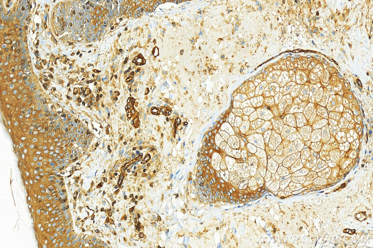 IHC staining of human skin cancer using 60233-1-Ig