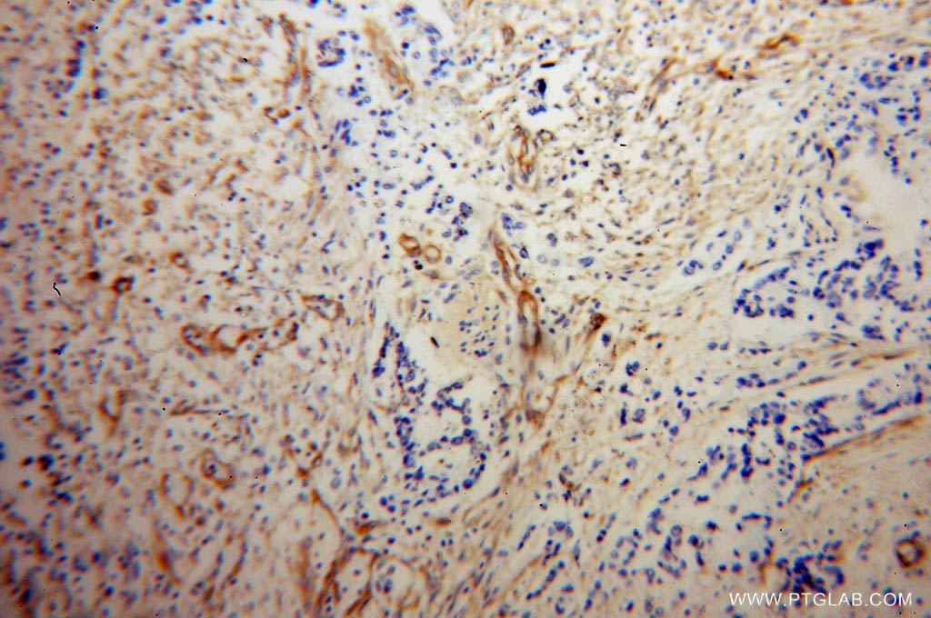 IHC staining of human colon cancer using 10324-1-AP