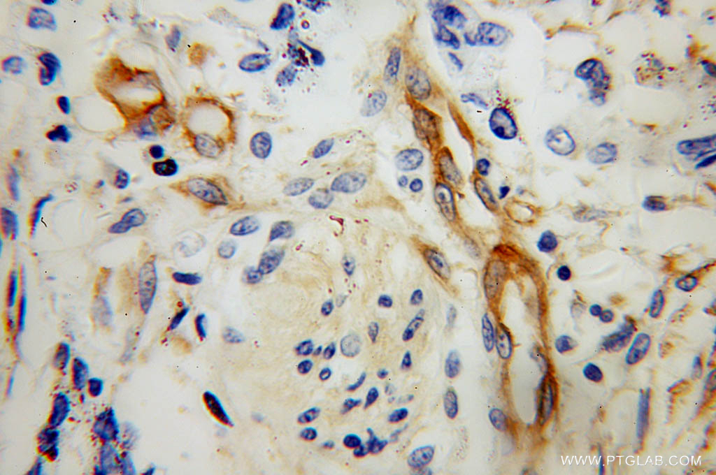 IHC staining of human colon cancer using 10324-1-AP