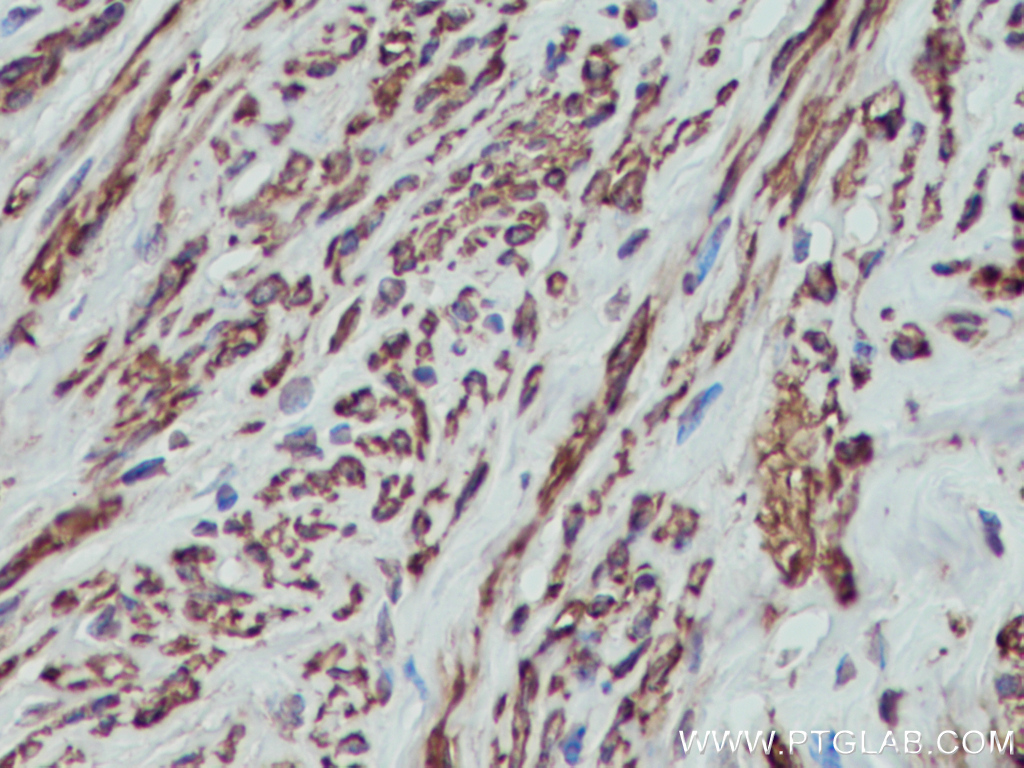 IHC staining of human cervical cancer using 14249-1-AP