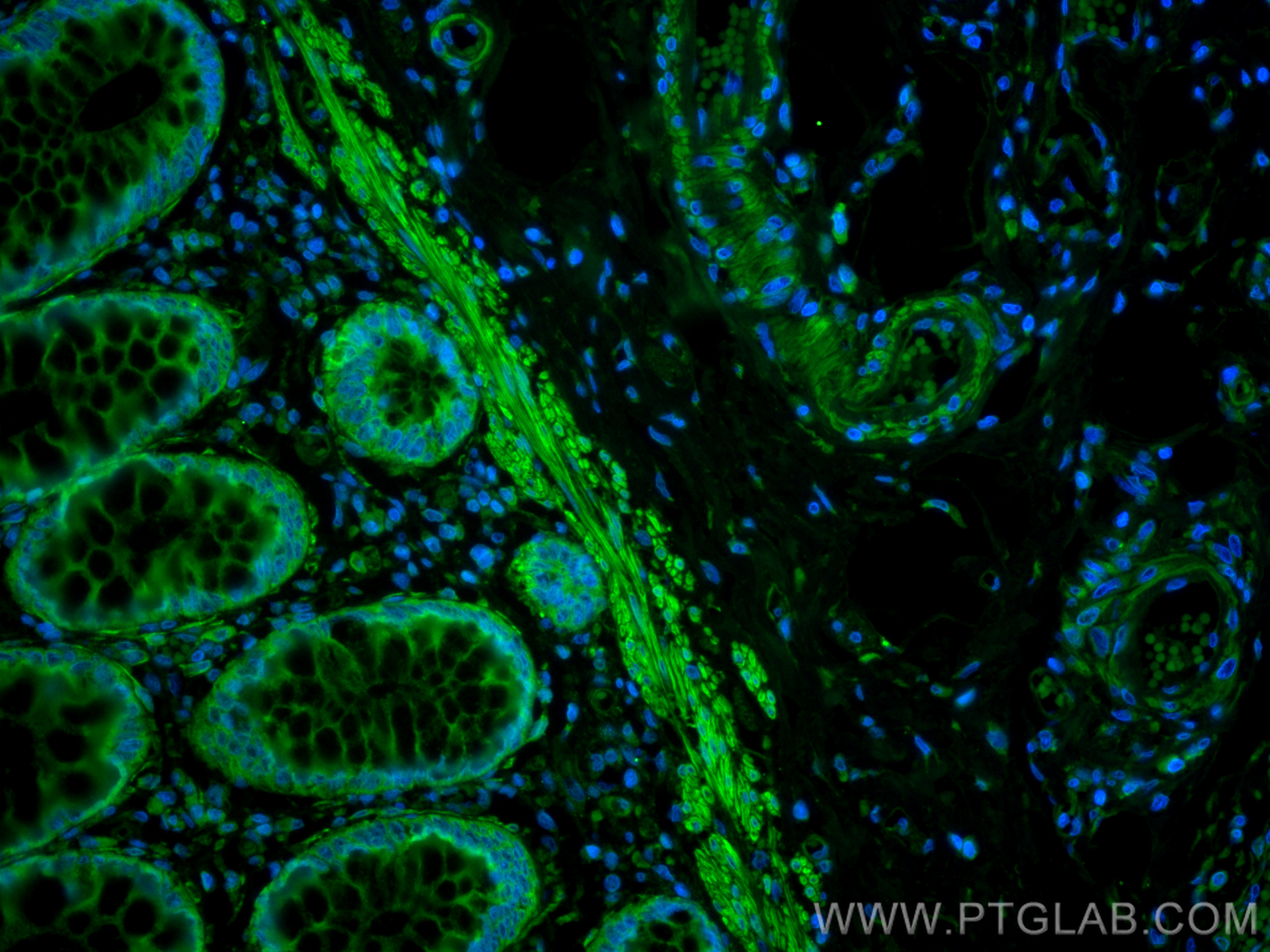 IF Staining of human rectal cancer using CL488-21642