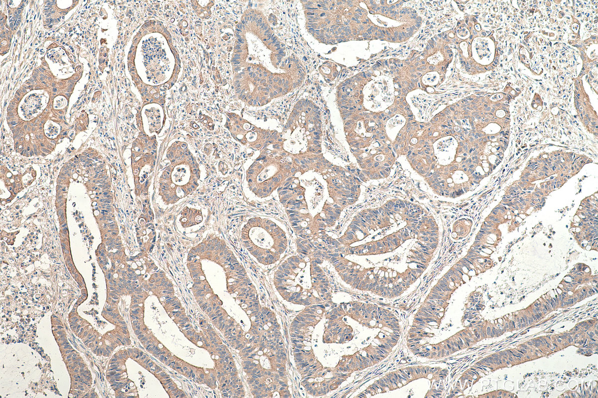 IHC staining of human colon cancer using 17969-1-AP