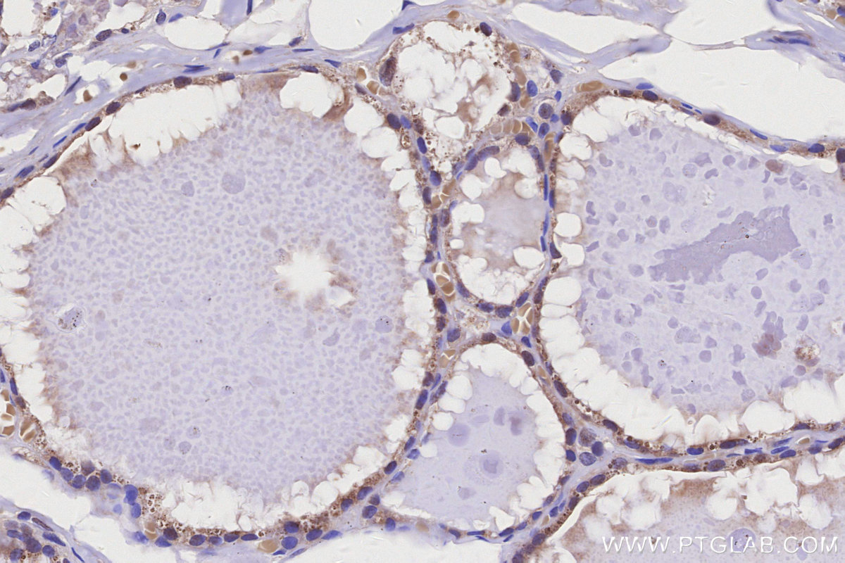 IHC staining of human thyroid cancer using 14028-1-AP IHC staining of human thyroid cancer using 14028-1-AP