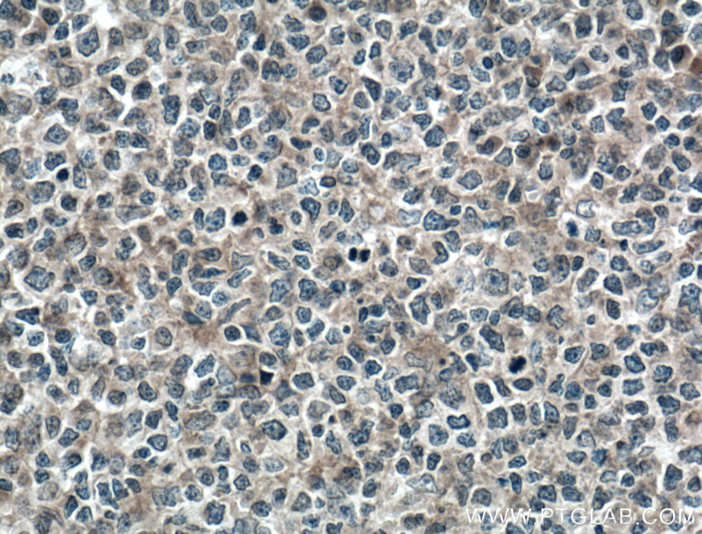 IHC staining of human tonsillitis using 12432-1-AP