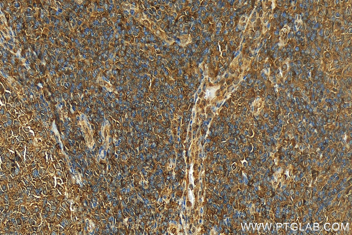 IHC staining of human tonsillitis using 12432-1-AP