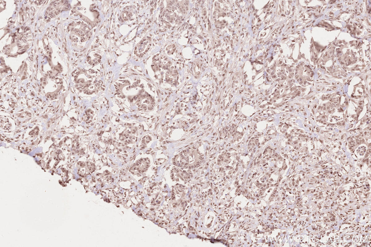 IHC staining of human rectal cancer using 16180-1-AP IHC staining of human rectal cancer using 16180-1-AP