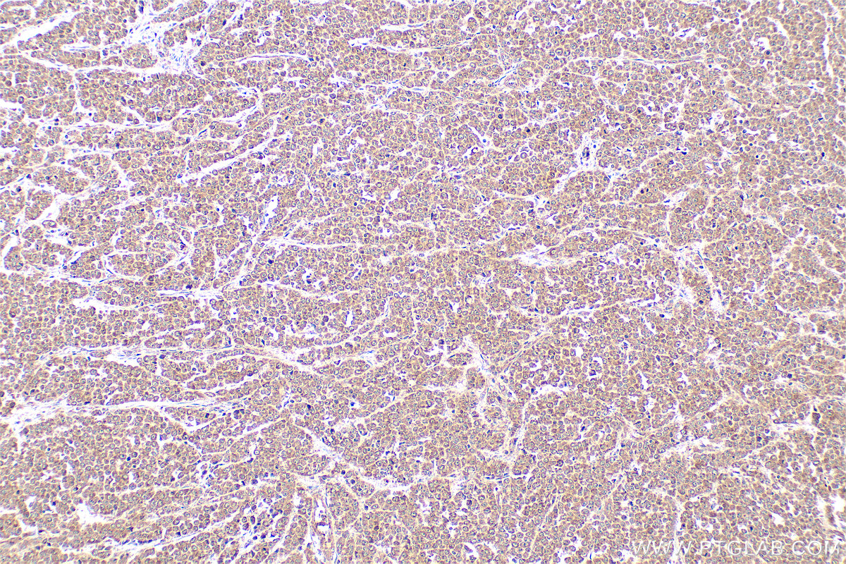 IHC staining of human colon cancer using 22117-1-AP