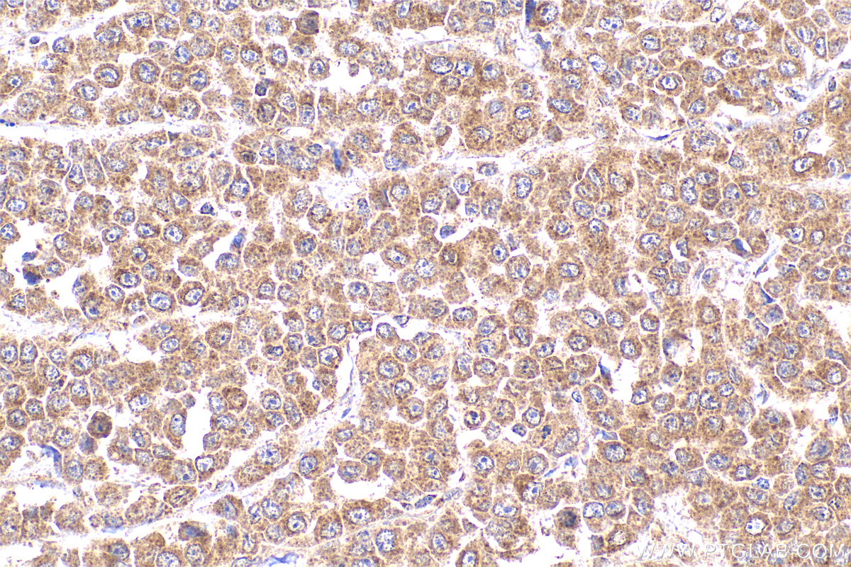 IHC staining of human colon cancer using 22117-1-AP