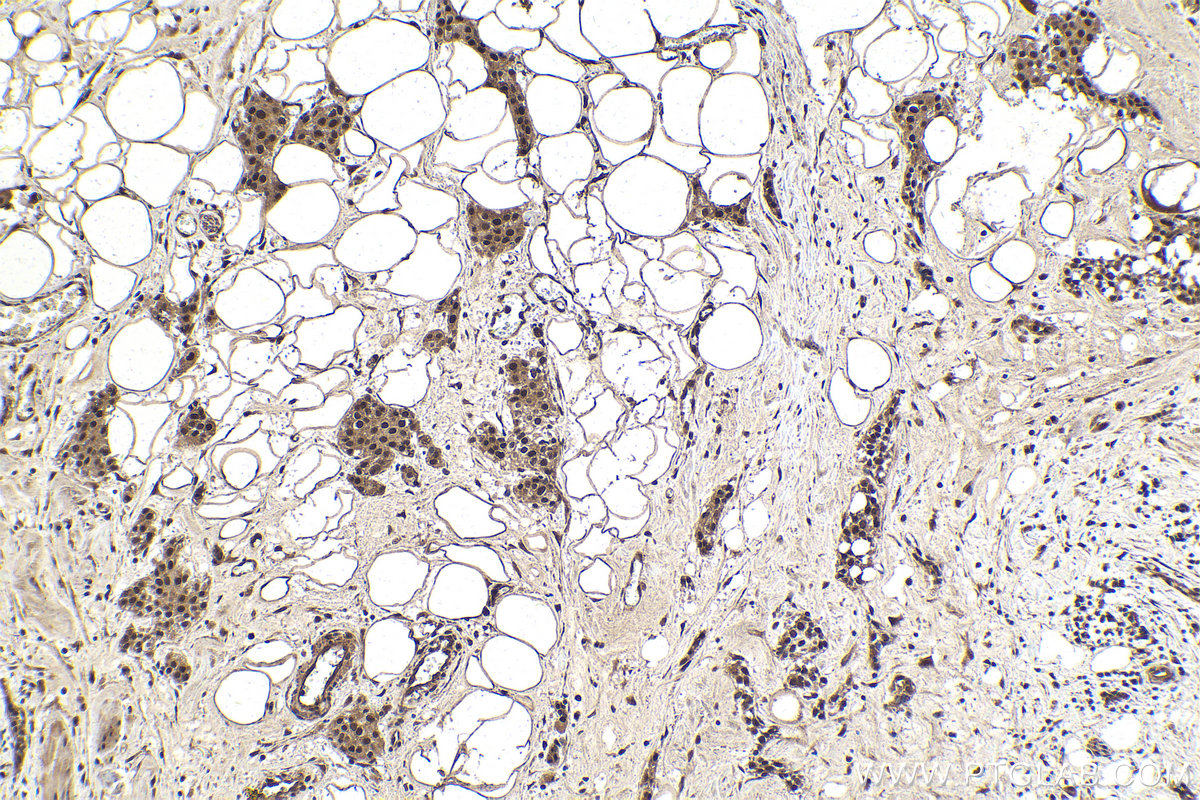 IHC staining of human urothelial carcinoma using 20078-1-AP
