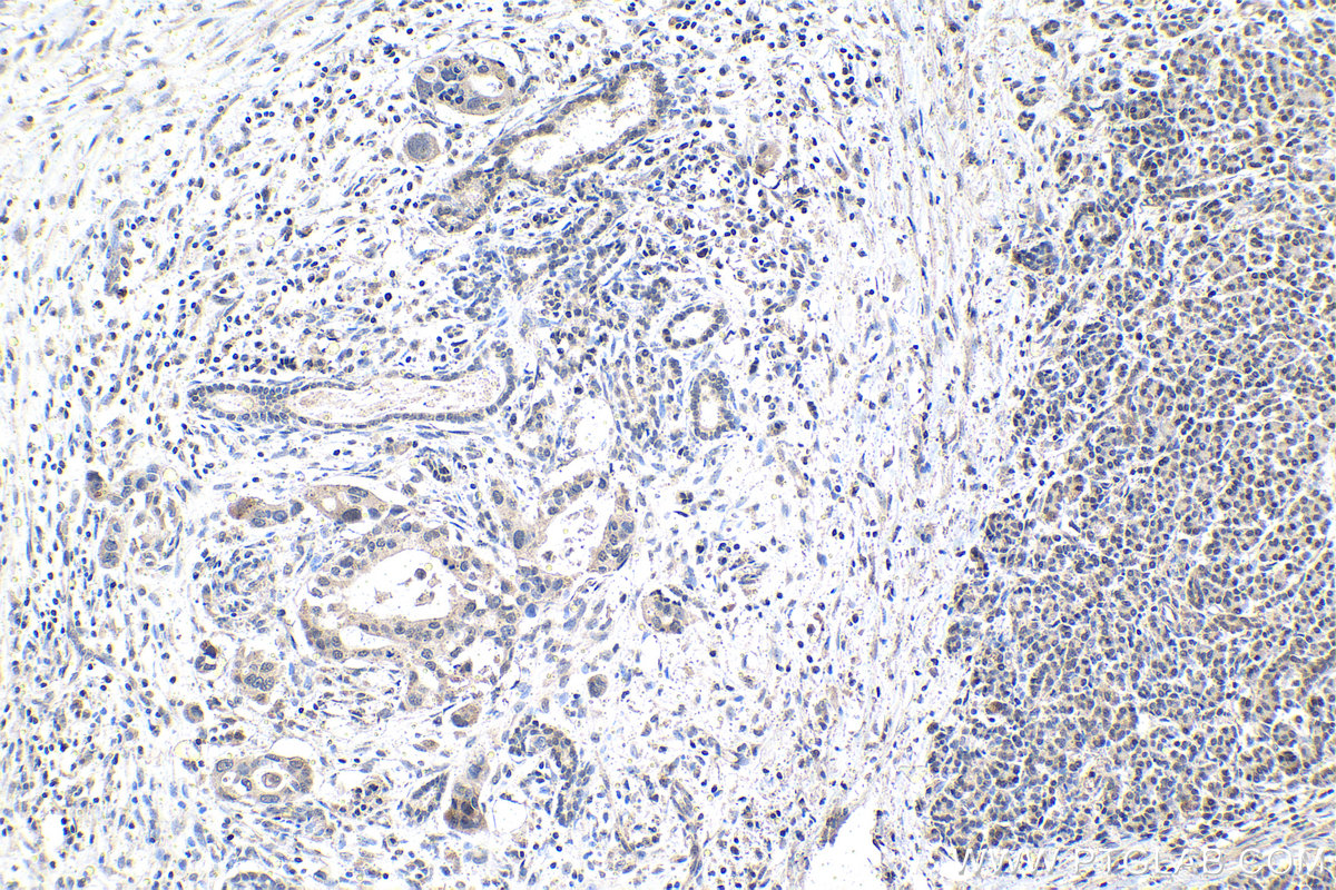 IHC staining of human pancreas cancer using 13751-1-AP