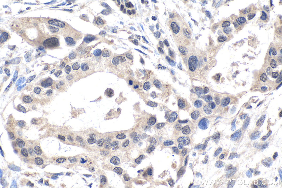IHC staining of human pancreas cancer using 13751-1-AP