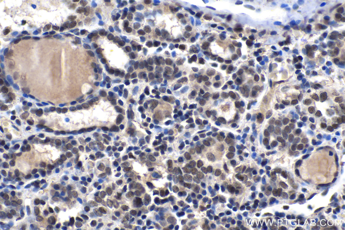 IHC staining of human thyroid cancer using 13751-1-AP