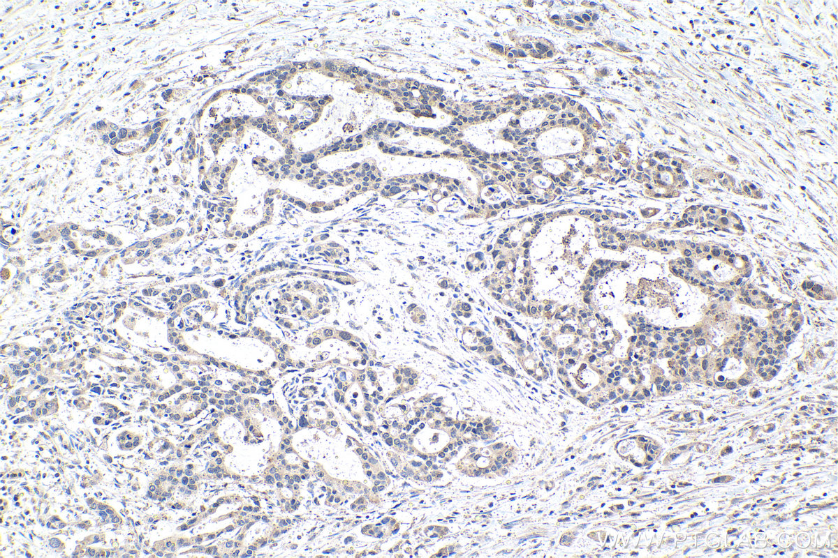 IHC staining of human pancreas cancer using 13751-1-AP