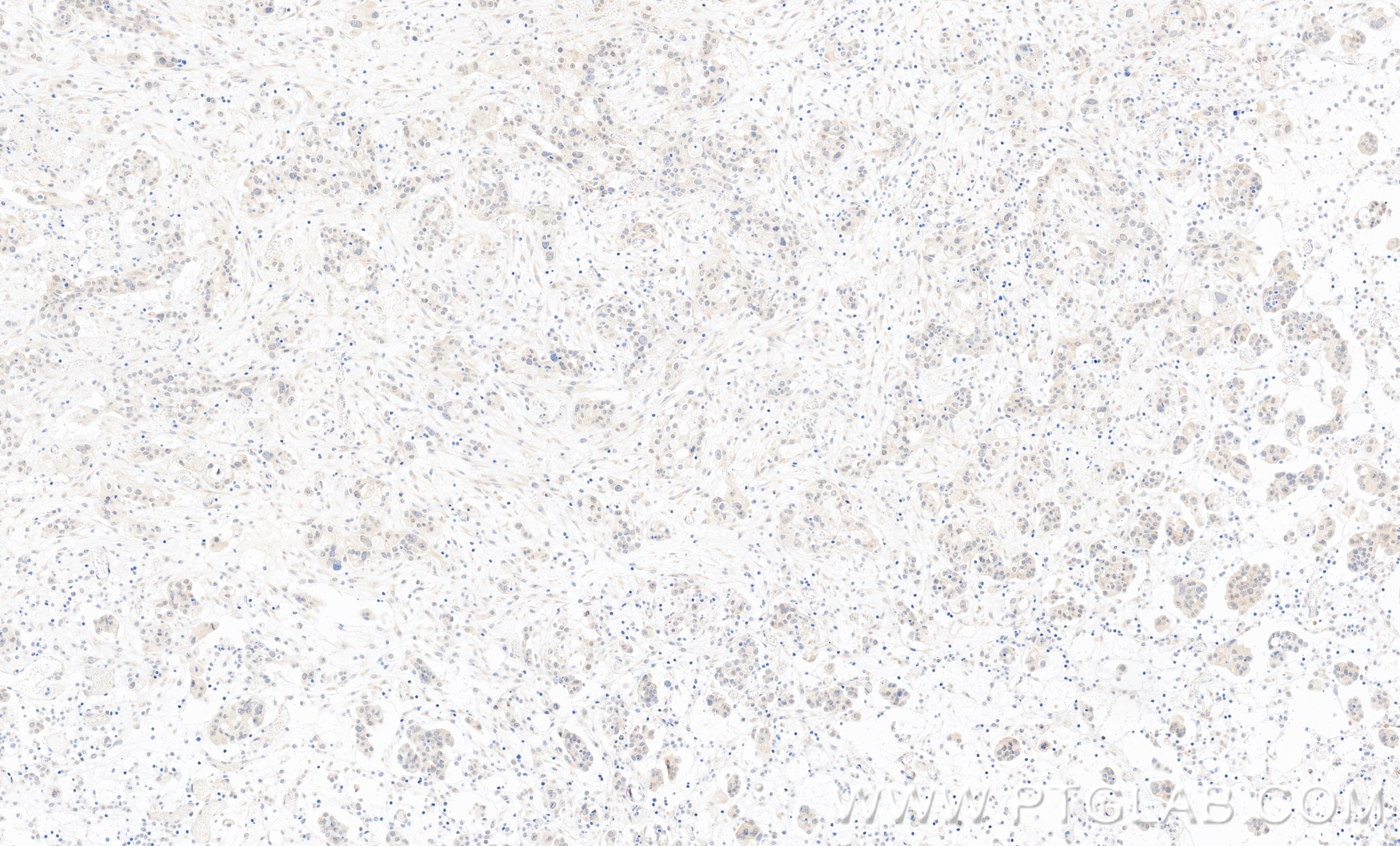 IHC staining of human ovary cancer using 86486-1-RR