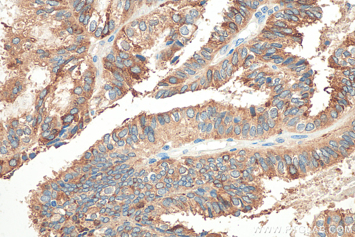 IHC staining of human ovary tumor using 21211-1-AP