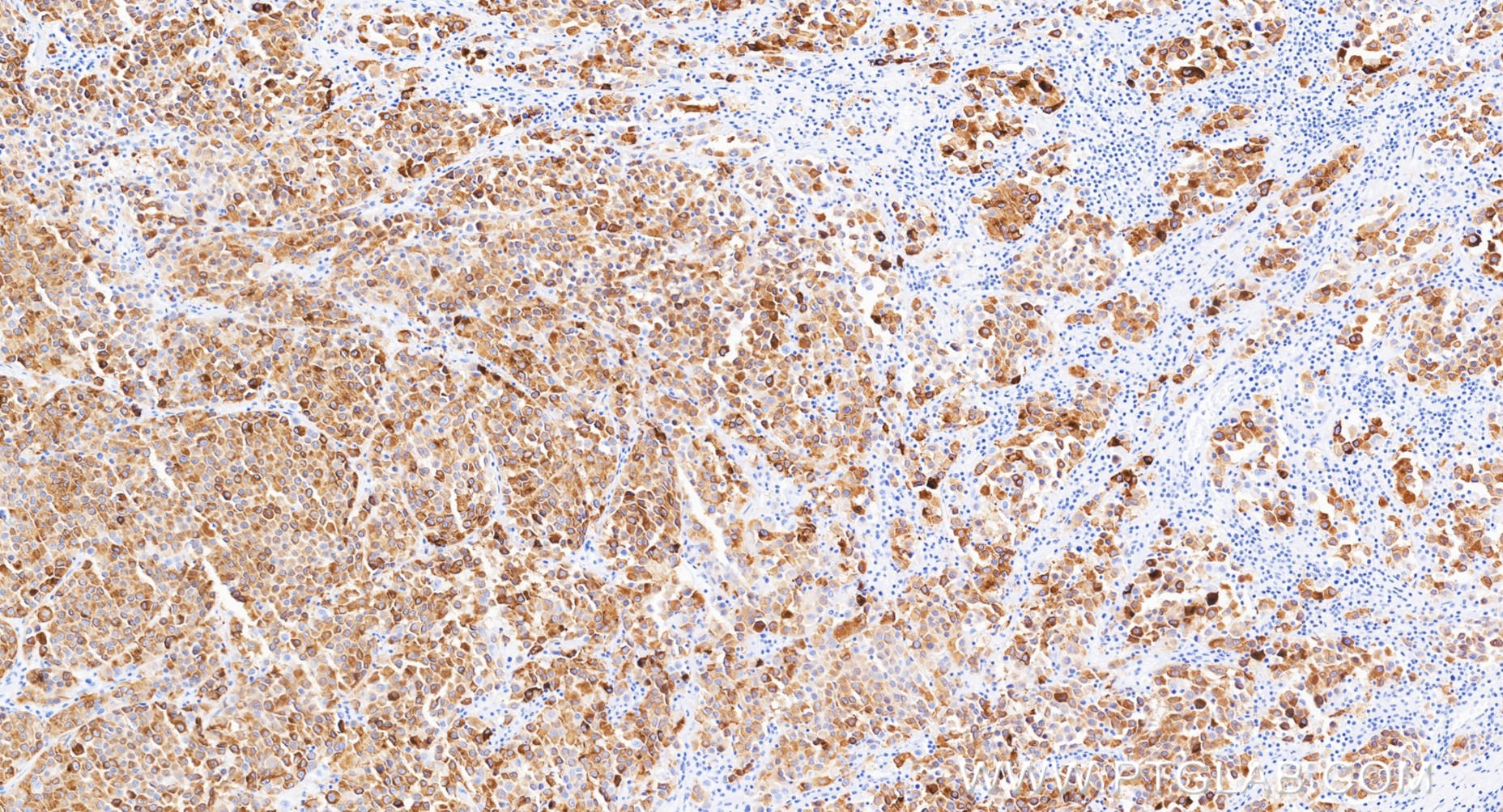 IHC staining of human malignant melanoma using 87351-4-PBS