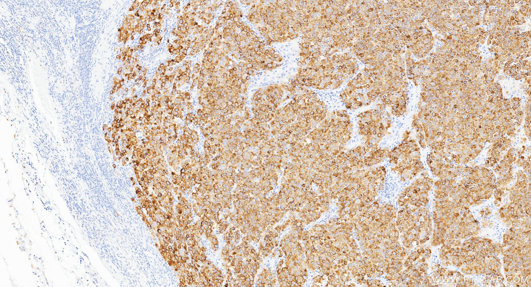 IHC staining of human malignant melanoma using Biotin-87351-4 IHC staining of human malignant melanoma using Biotin-87351-4