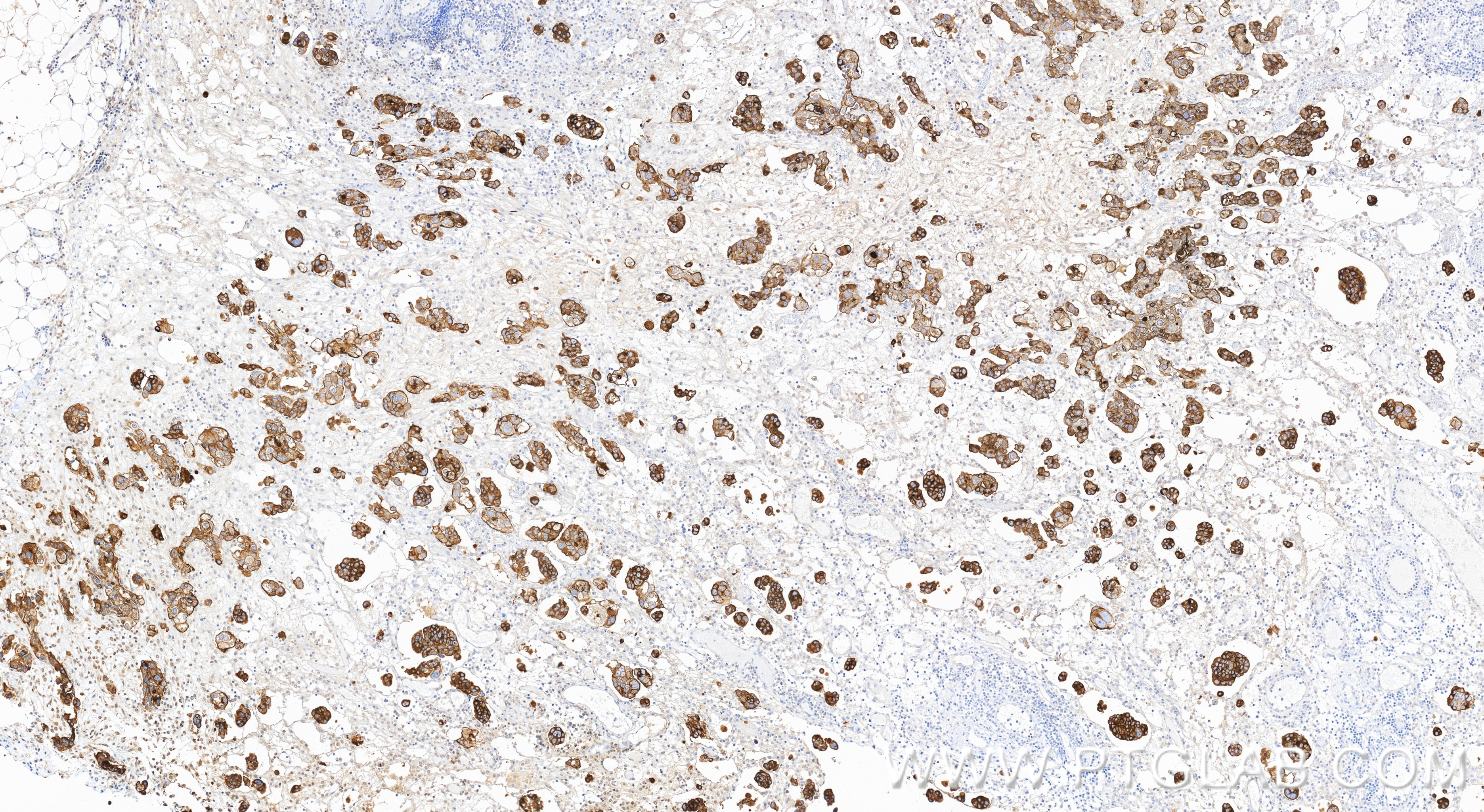 IHC staining of human ovary cancer using 98776-3-RR (same clone as 98776-3-PBS) IHC staining of human ovary cancer using 98776-3-RR (same clone as 98776-3-PBS)