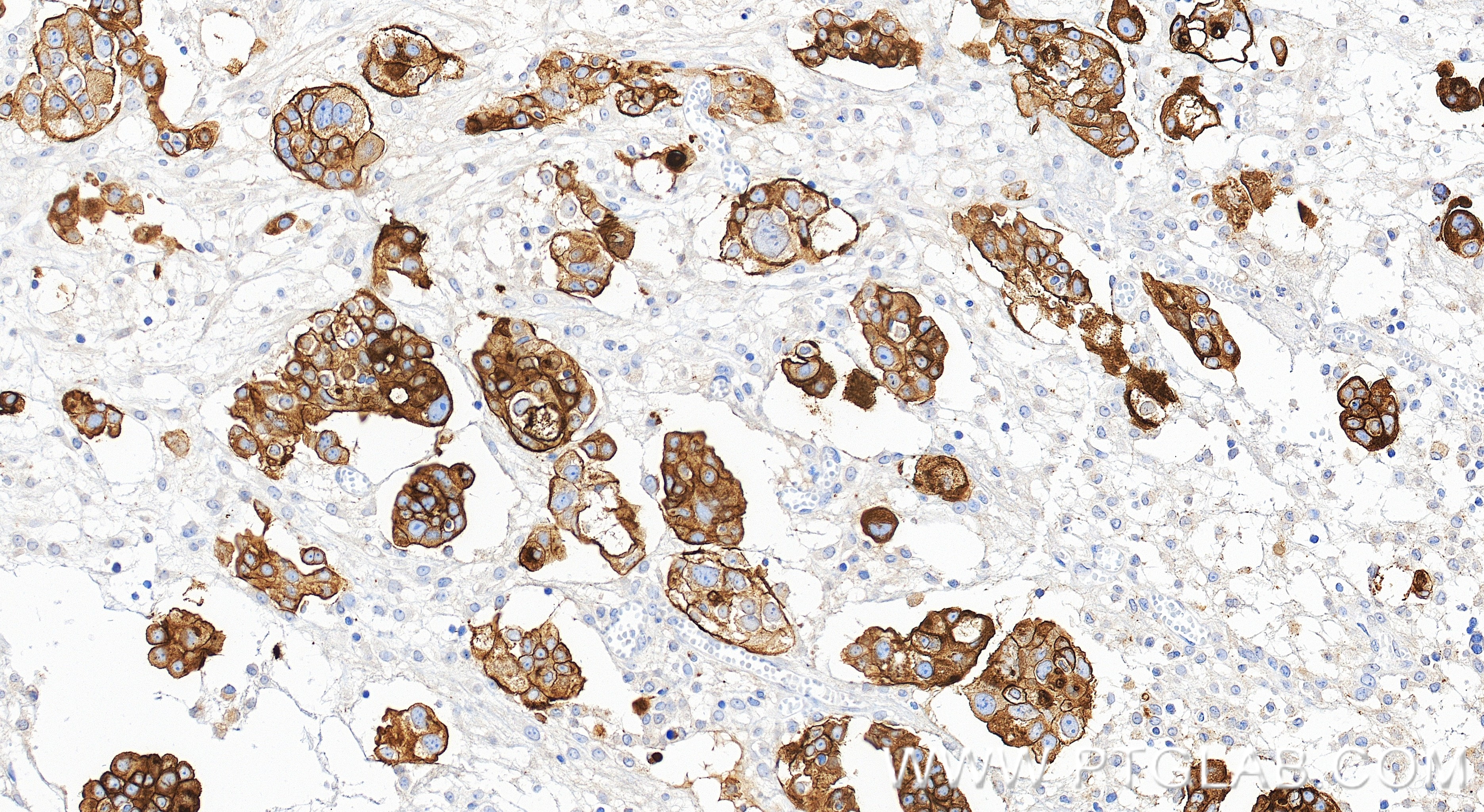 IHC staining of human ovary cancer using 98776-3-RR (same clone as 98776-3-PBS) IHC staining of human ovary cancer using 98776-3-RR (same clone as 98776-3-PBS)