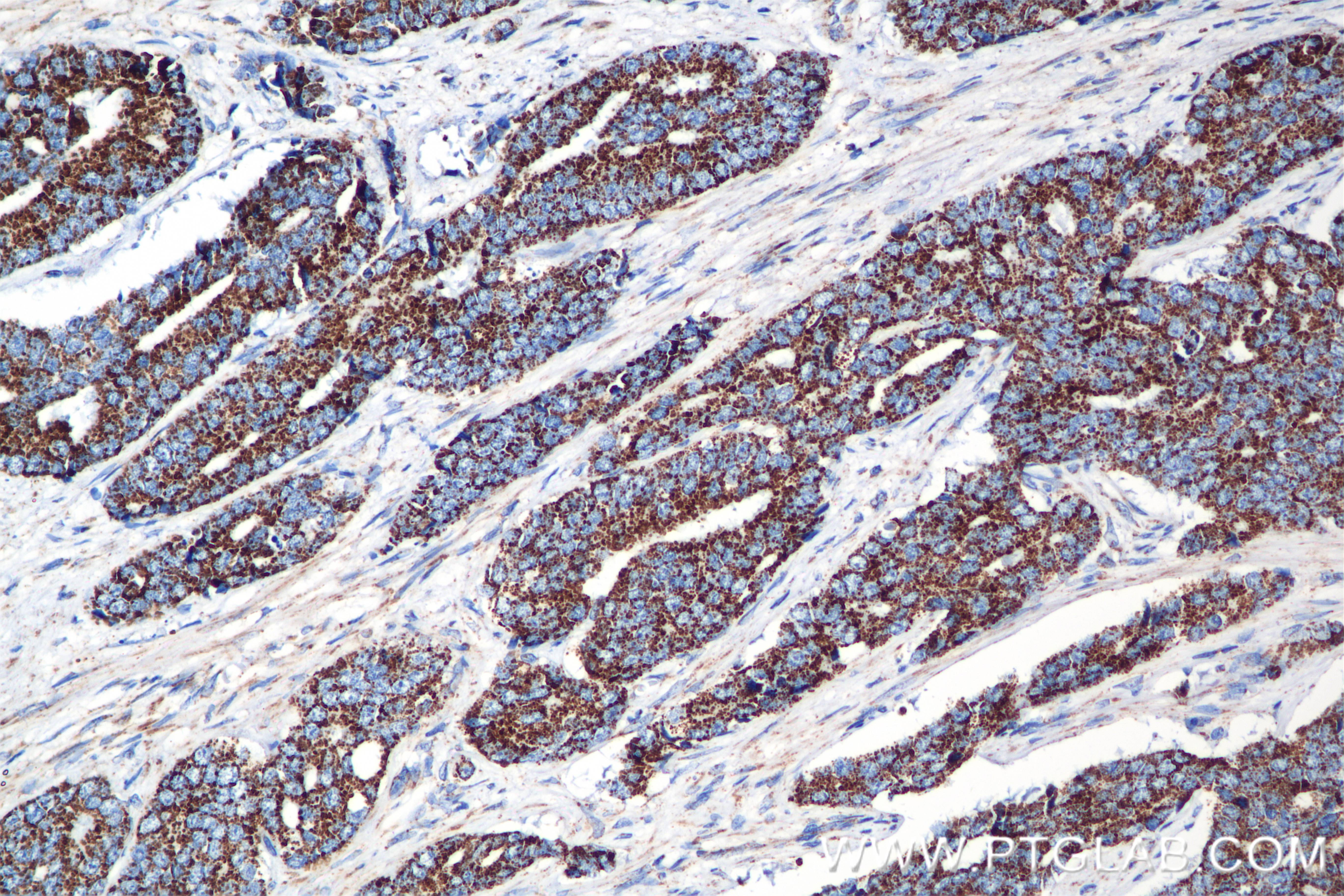 IHC staining of human prostate cancer using 84879-5-RR