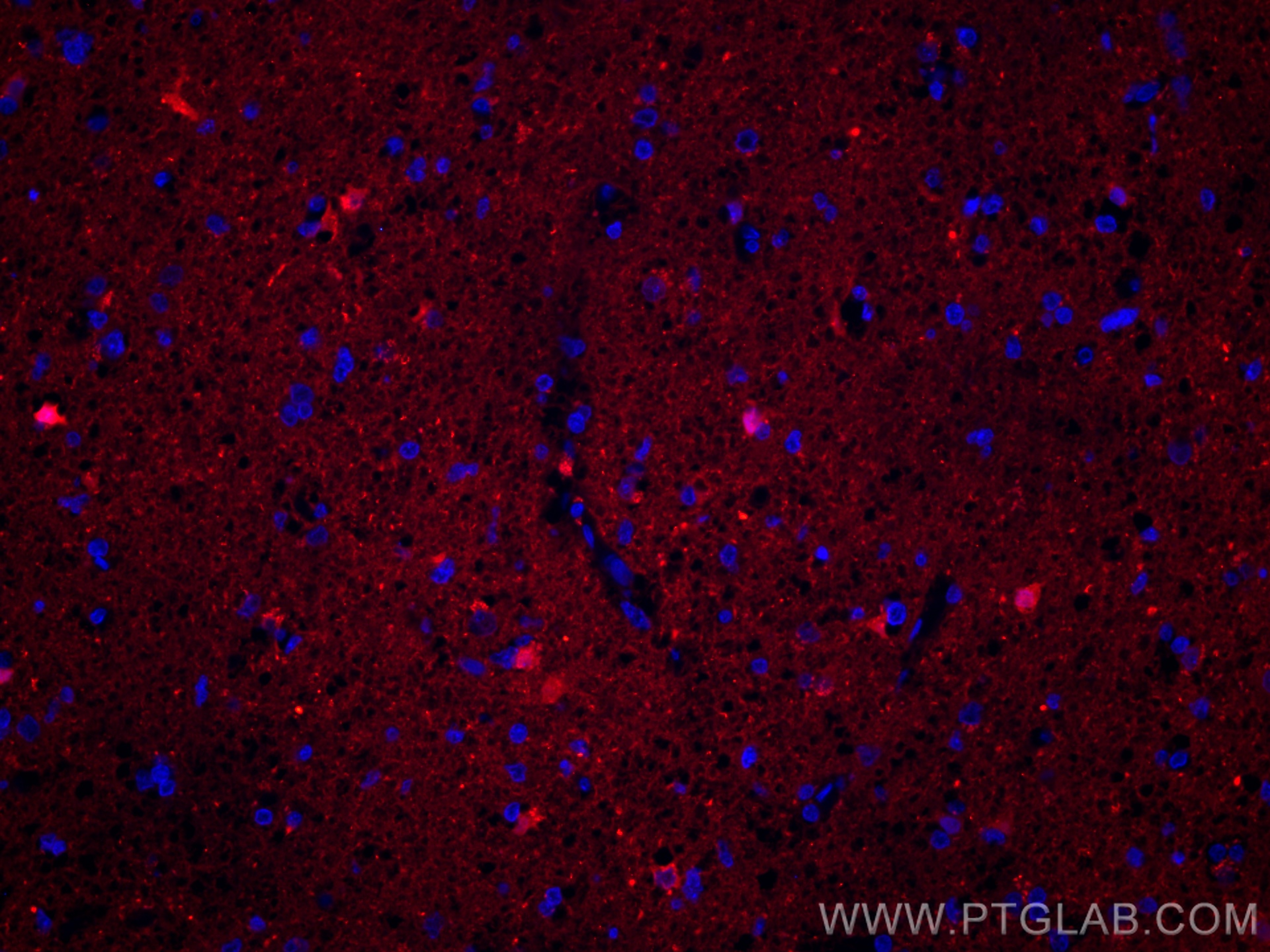 IF Staining of human gliomas using CL594-12495