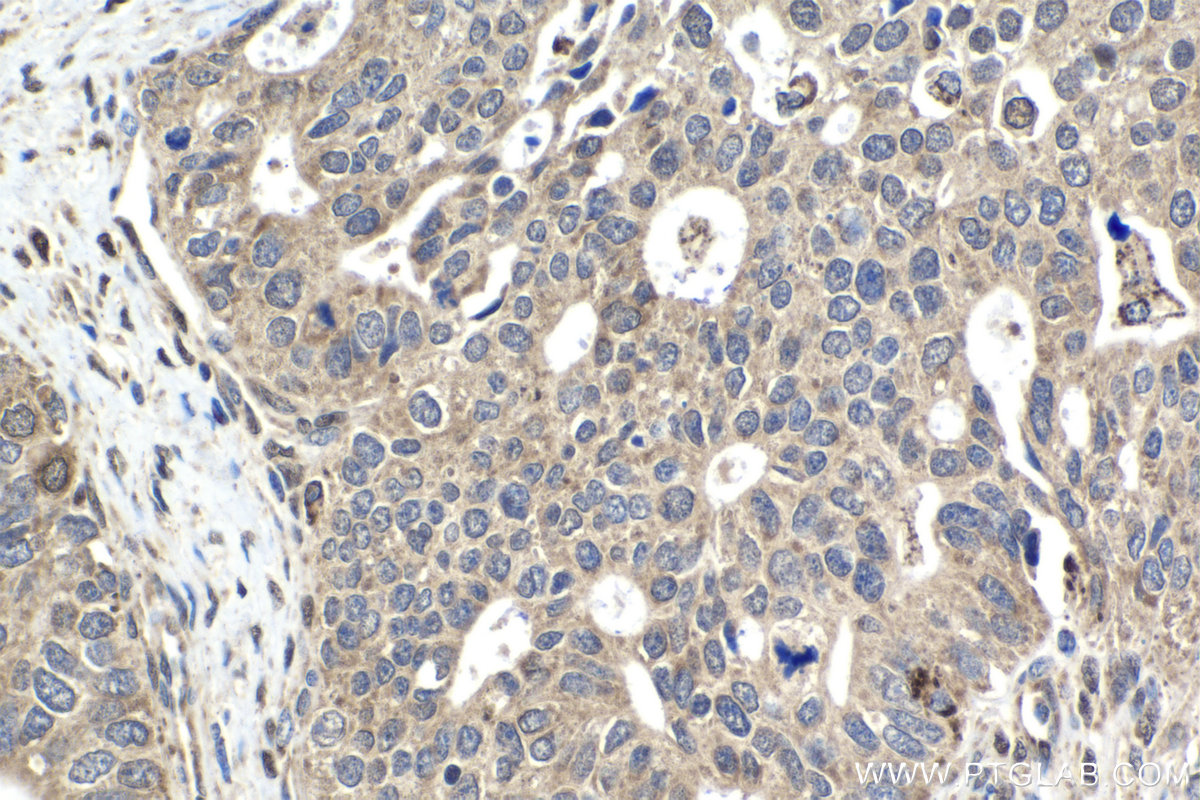 IHC staining of human ovary tumor using 10770-1-AP