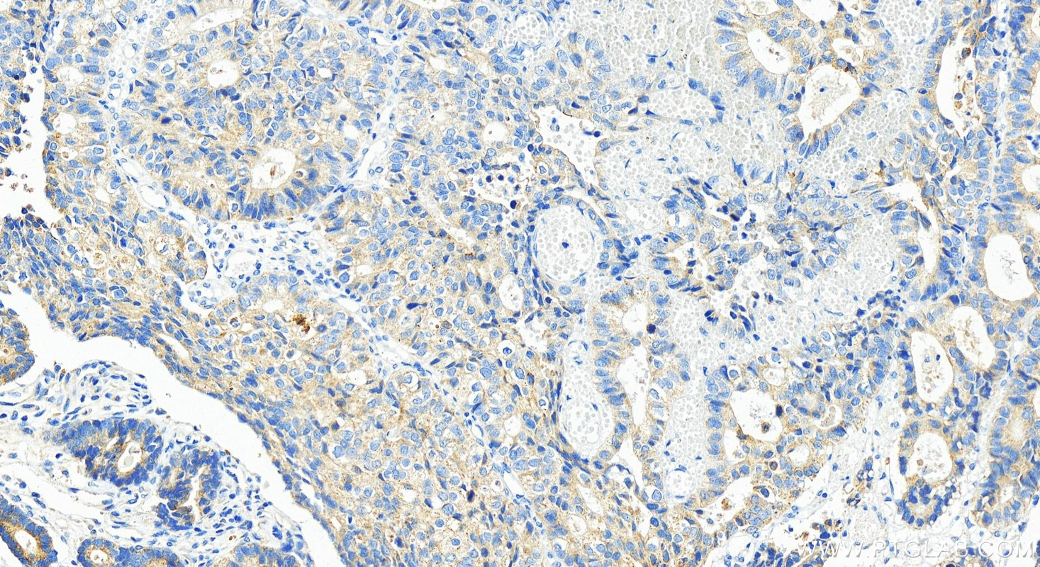 IHC staining of human stomach cancer using 25453-1-AP