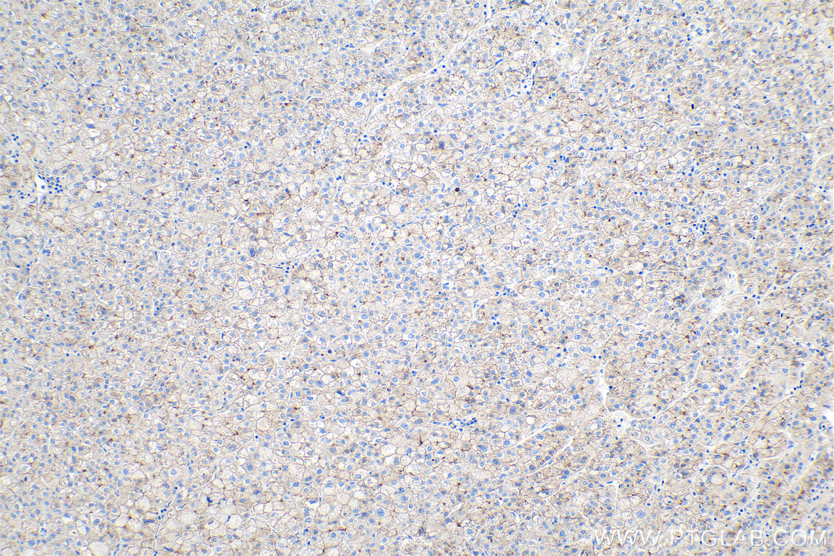 IHC staining of human liver cancer using 66219-1-Ig IHC staining of human liver cancer using 66219-1-Ig