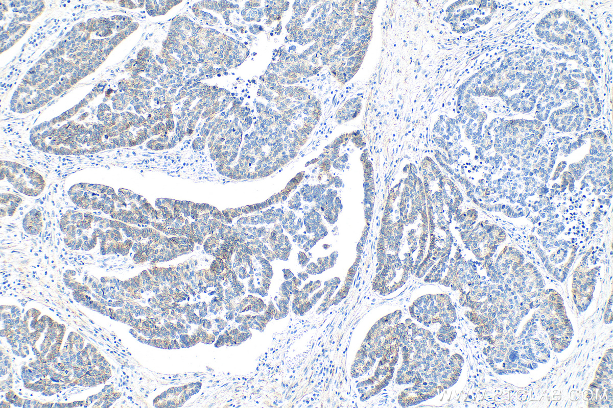 IHC staining of human ovary tumor using 66219-1-Ig (same clone as 66219-1-PBS)