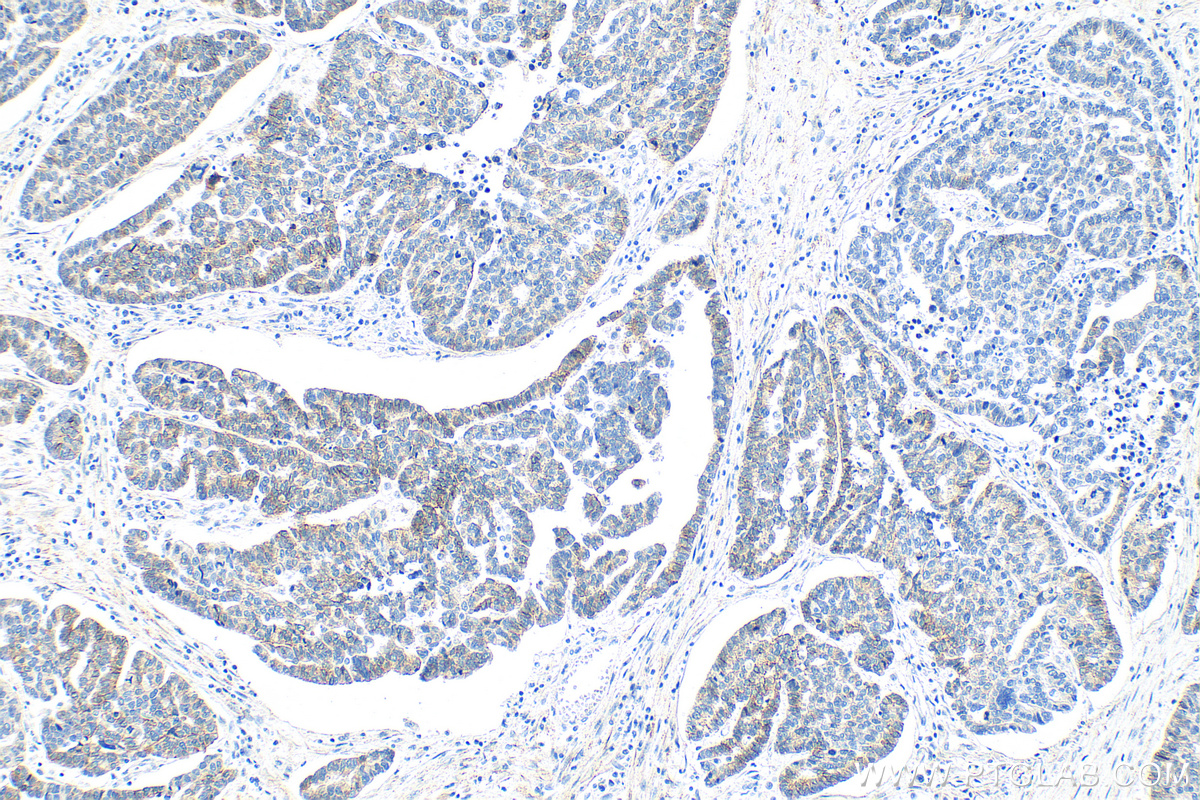 IHC staining of human ovary tumor using 66219-1-Ig