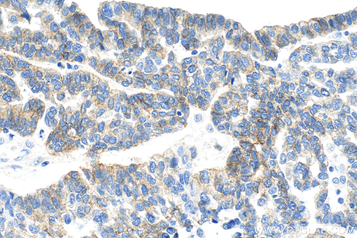 IHC staining of human ovary tumor using 66219-1-Ig (same clone as 66219-1-PBS)