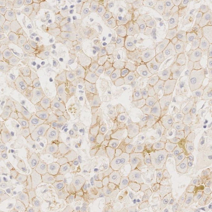 IHC staining of Cholangiocarcinoma using 66219-1-Ig IHC staining of Cholangiocarcinoma using 66219-1-Ig