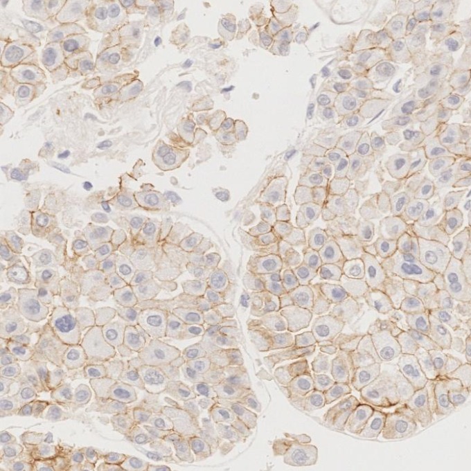 IHC staining of human liver cancer using 66219-1-Ig IHC staining of human liver cancer using 66219-1-Ig