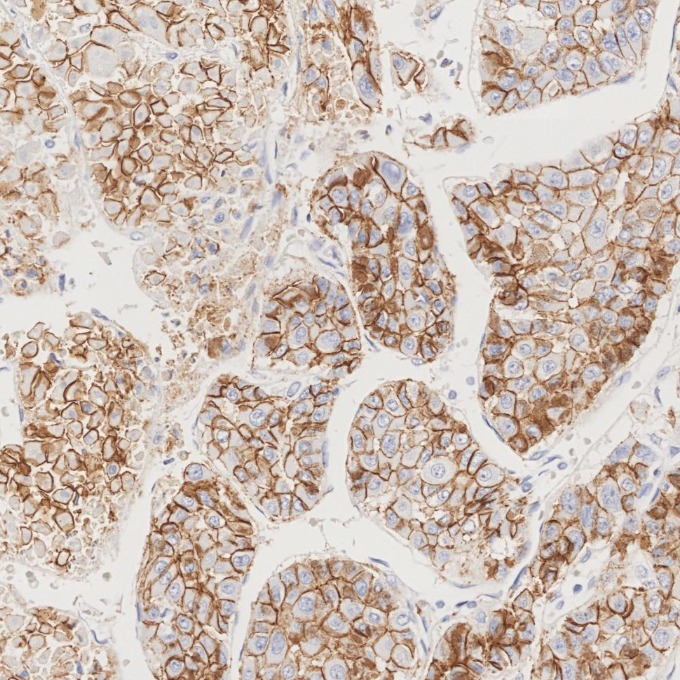 IHC staining of human liver cancer using 82968-1-RR IHC staining of human liver cancer using 82968-1-RR